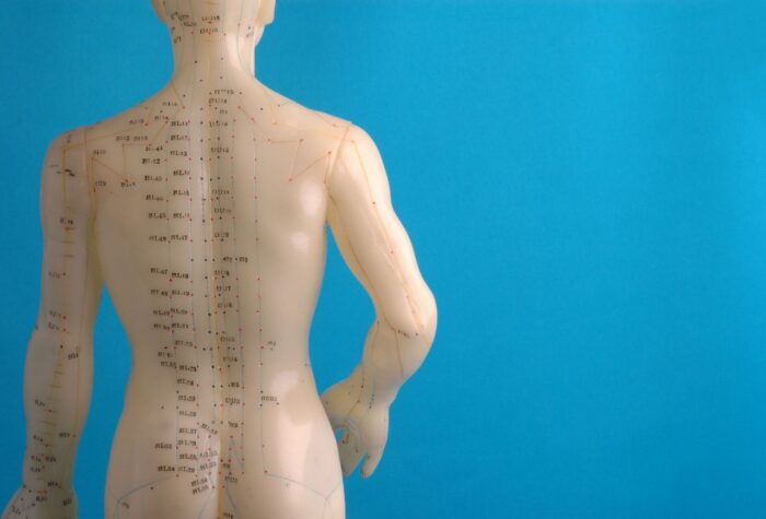 Acupuncture
