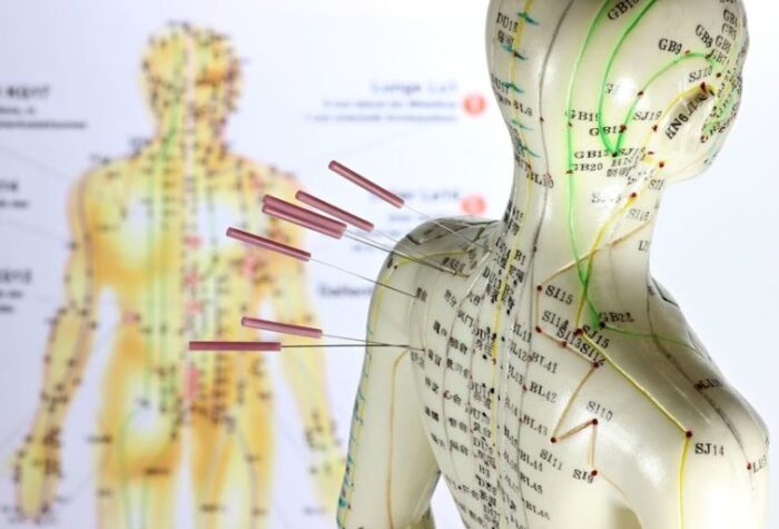 Acupuncture model with needles